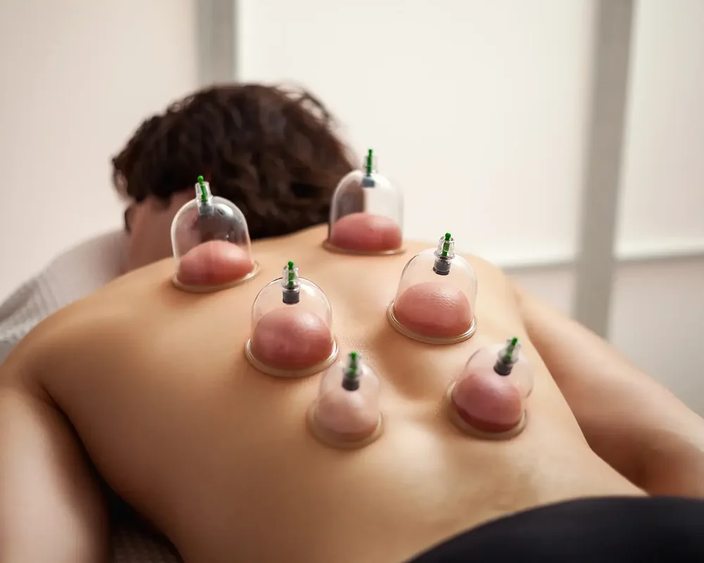 Cupping therapy cups placed along a patient&rsquo;s upper back at King Physical Therapy and Fitness in Connellsville, PA