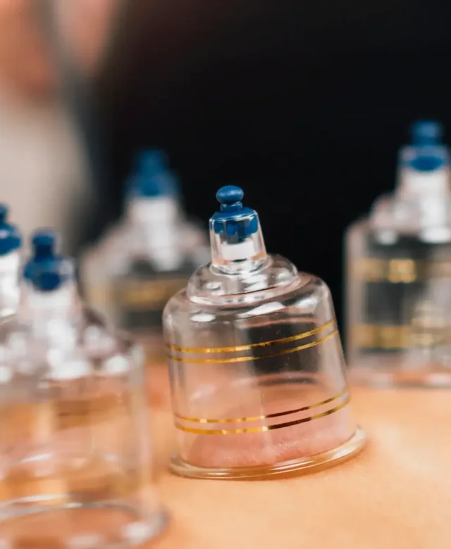 Cups placed along a patient&rsquo;s low back during a cupping session at King Physical Therapy and Fitness