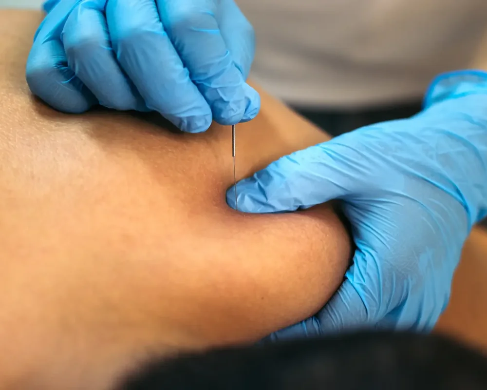 Dry needling treatment of a trigger point at King Physical Therapy and Fitness in Connellsville, PA