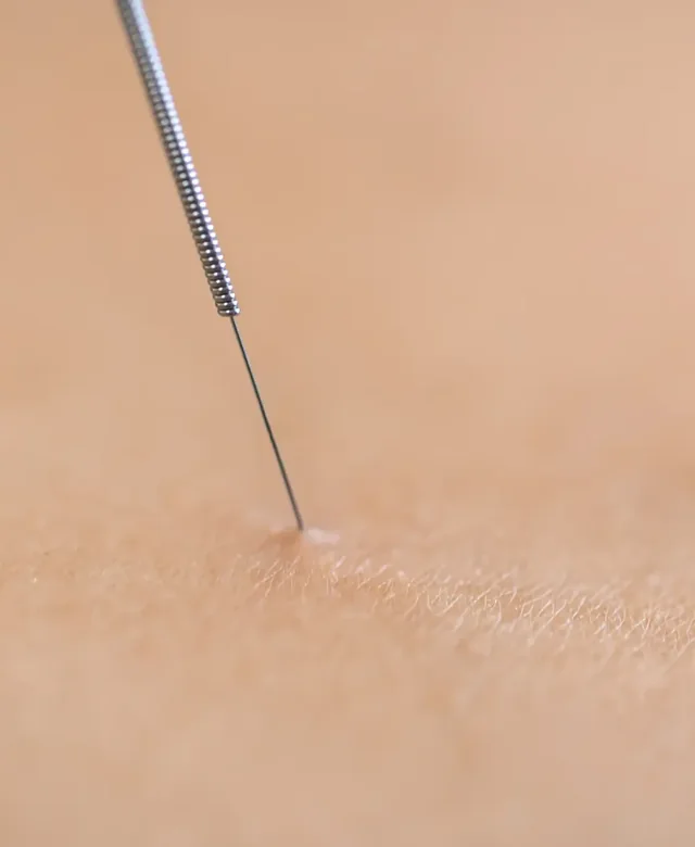 Licensed physical therapist checking a treated muscle after dry needling at King Physical Therapy and Fitness